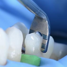 LM-Arte™ Cusp Misura